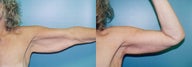 Brachioplasty
