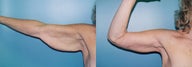 Brachioplasty
