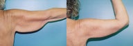 Brachioplasty