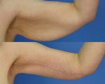 Brachioplasty - Arm Lift