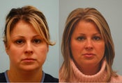 Artefill, Silicone, Restylane, Perlane