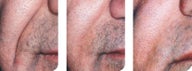 Artefill for nasolabial fold repair