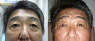 Cosmetic eyelid surgery