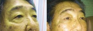 Cosmetic eyelid surgery
