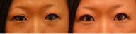 Asian Blepharoplasty ("Double Eyelid" Procedure)