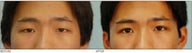 Asian Blepharoplasty ("Double Eyelid" Procedure)