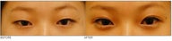 Asian Blepharoplasty ("Double Eyelid" Procedure)