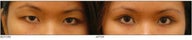 Asian Blepharoplasty ("Double Eyelid" Procedure)