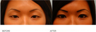 Asian Blepharoplasty ("Double Eyelid" Procedure)