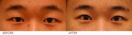 Asian Blepharoplasty