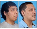 Asian Rhinoplasty and Genioplasty