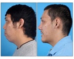 Asian Rhinoplasty and Genioplasty
