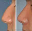 Nose