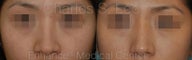 Nose