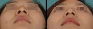 Nose