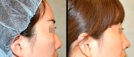 Rhinoplasty