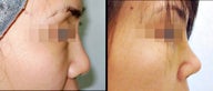 Rhinoplasty