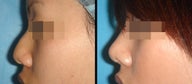 Rhinoplasty