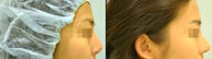 Rhinoplasty