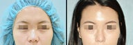 Rhinoplasty