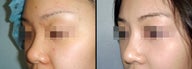 Rhinoplasty
