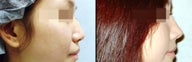 Rhinoplasty