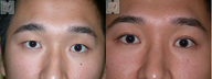Asian Blepharoplasty