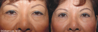 Asian Double Fold Eyelid Surgery
