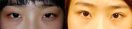 Suture Technique Asian Upper Eyelid Surgery