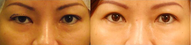 Asian Eyelid Surgery