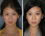Blepharoplasty, Rhinoplasty and Chin Augmentation