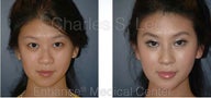Blepharoplasty, Rhinoplasty and Chin Augmentation