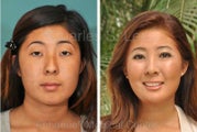Eyelid, Nose and Chin