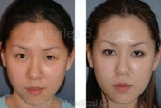 Blepharoplasty