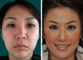 Blepharoplasty