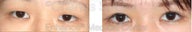 Blepharoplasty