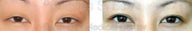 Blepharoplasty