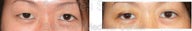Blepharoplasty