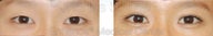 Blepharoplasty