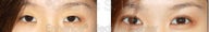 Blepharoplasty