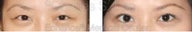 Blepharoplasty