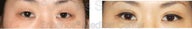Blepharoplasty
