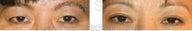 Blepharoplasty