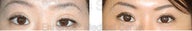 Blepharoplasty