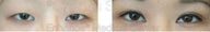 Blepharoplasty