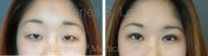 Blepharoplasty