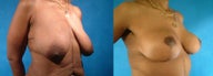 Breast and Body Lift