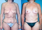 Upper Body & Back Lift After Major Weight Loss