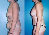 Upper Body & Back Lift After Major Weight Loss