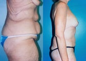 Upper Body & Back Lift After Major Weight Loss